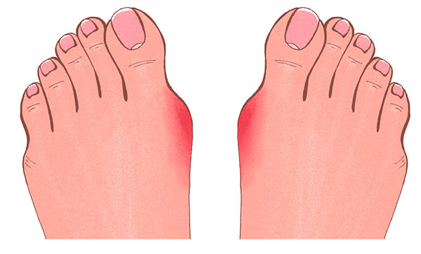 Drawing of two feet with bunions at the ball of the foot